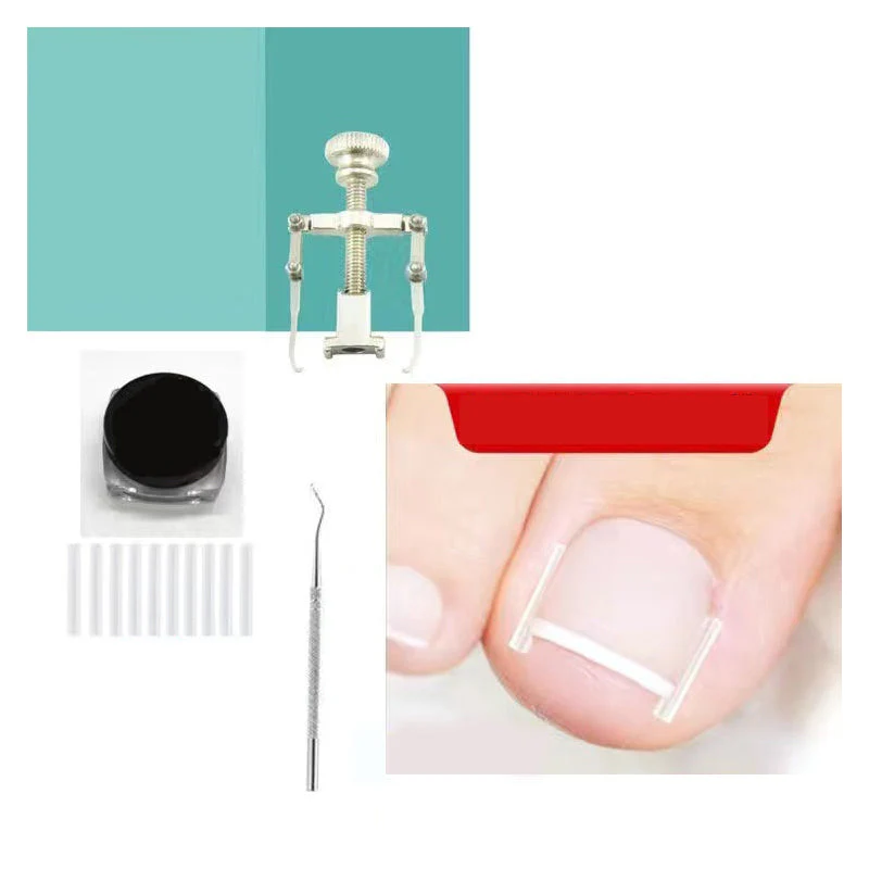 Ingrown Toenail Treatment Corrector Set - Image 10