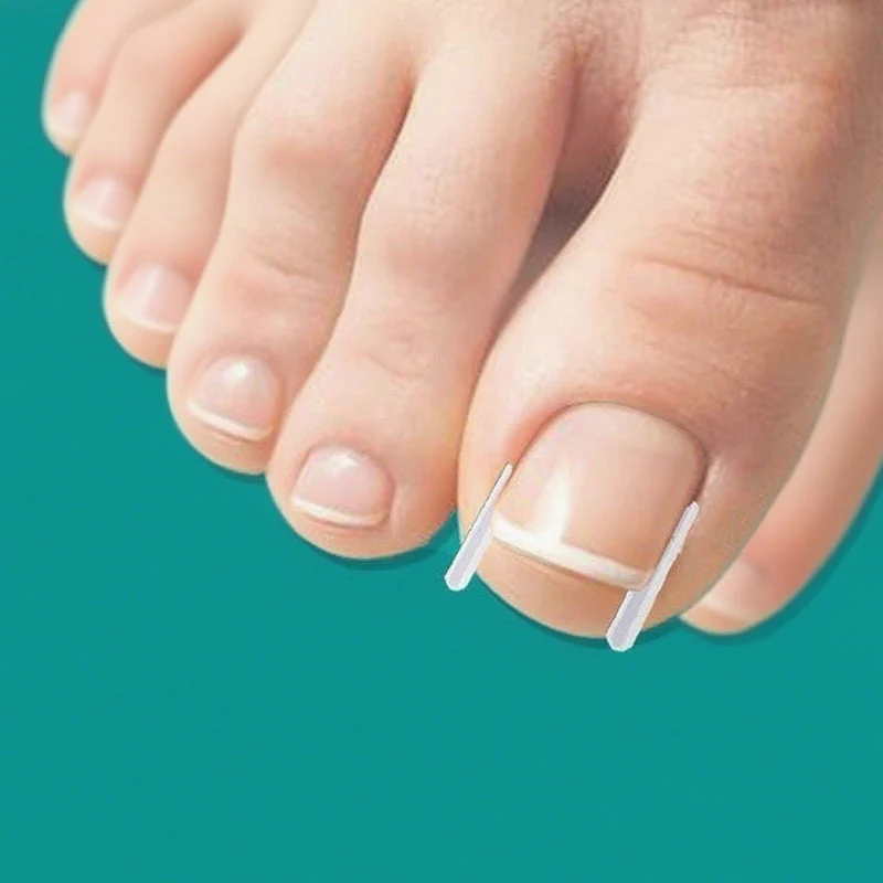 Ingrown Toenail Treatment Corrector Set - Image 4