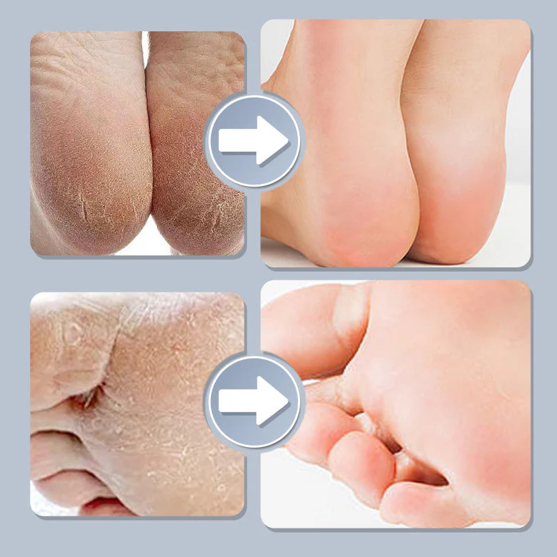Household Adjustable Electric Foot Callus Remover - Image 3